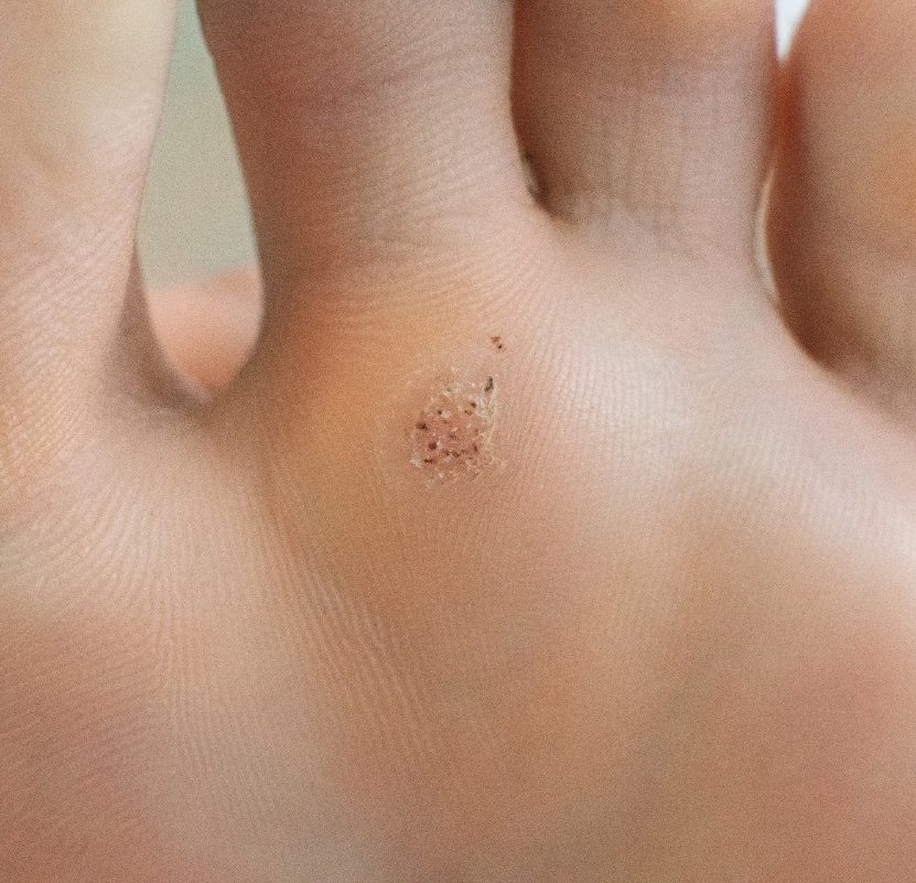 the bottom of a foot that has a wart